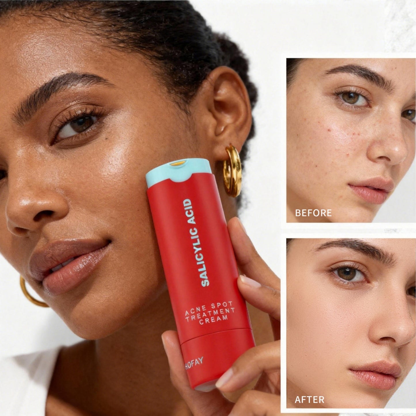 Loción para Eliminar el Acné C-S003